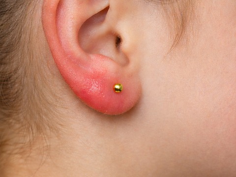 An earlobe wearing an ordinary gold-colored stud, red and inflamed.